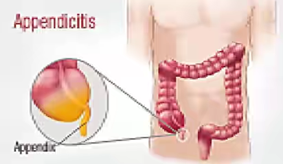 APPENDICITIS: Abdominal pain with  a difference!