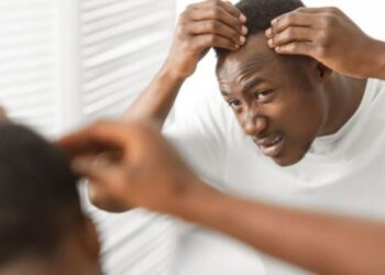 Here’s why men are balding in their 20s